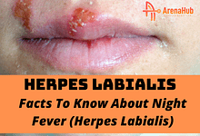 Herpes Labialis: Definition, Causes, Symptoms, Treatment